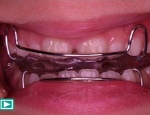 咬合育成とは お子様の正しい歯並びをサポート