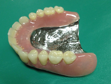 入れ歯の厚みを薄く出来るため、快適に使うことができる金属床